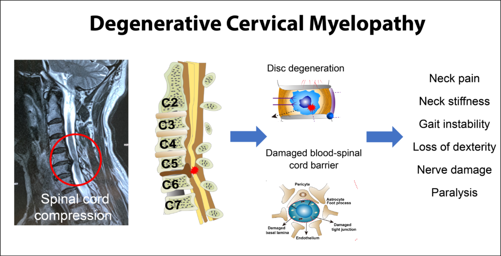 Cervical Myelopathy