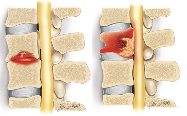 Spinal Infection – EndoSpine Hospital