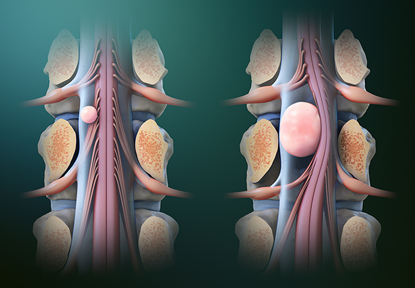 Spinal Tumor